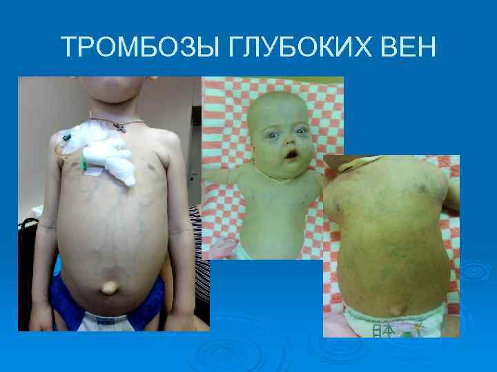 ТРОМБОЗЫ ГЛУБОКИХ ВЕН 