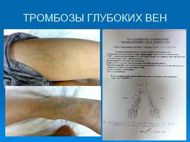 ТРОМБОЗЫ ГЛУБОКИХ ВЕН 