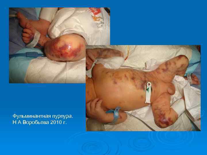 Фульминантная пурпура. Н А Воробьева 2010 г. 