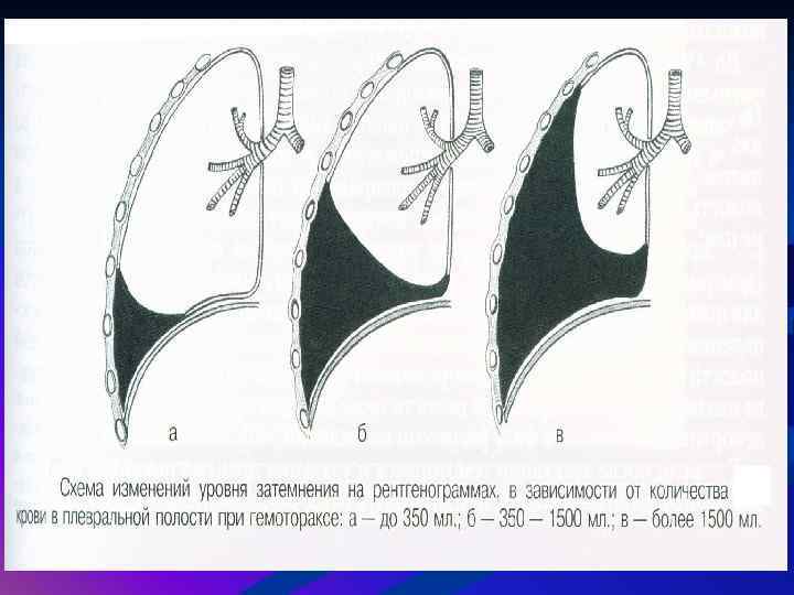 Плеврит карта смп