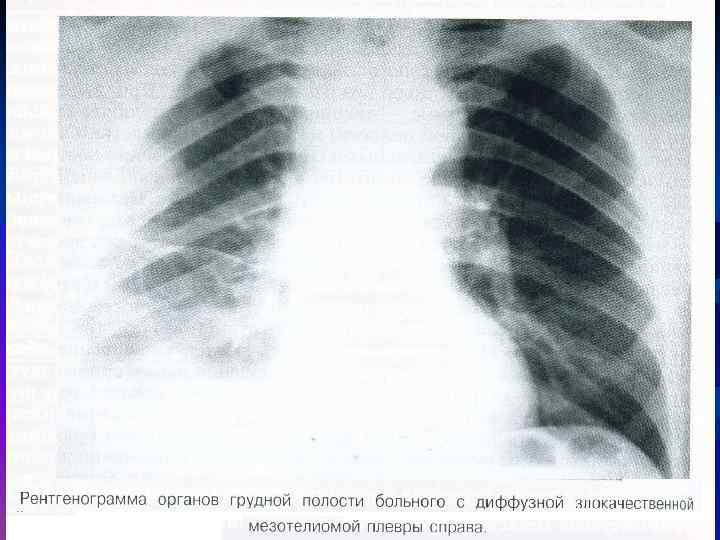 Девичья плевра фото