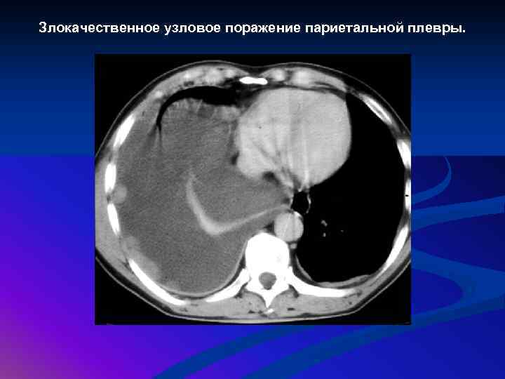 Злокачественное узловое поражение париетальной плевры. 