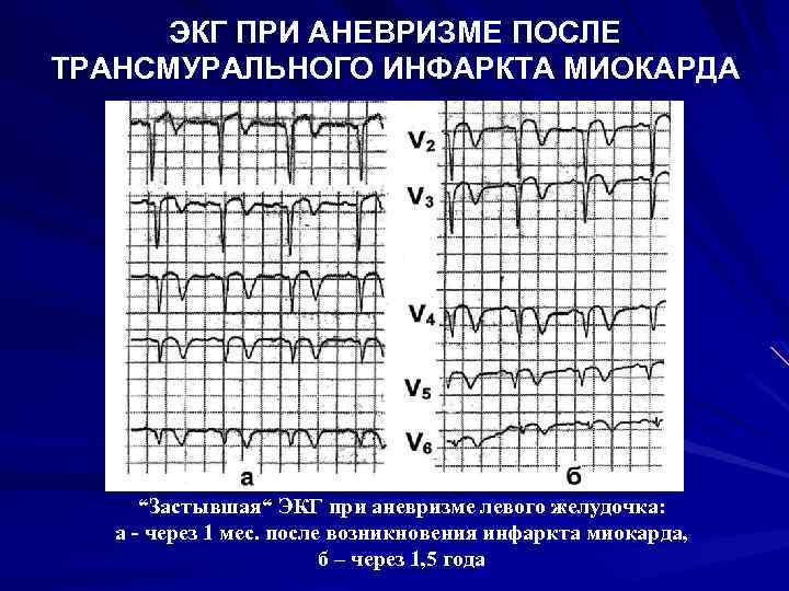 ЭКГ ПРИ АНЕВРИЗМЕ ПОСЛЕ ТРАНСМУРАЛЬНОГО ИНФАРКТА МИОКАРДА “Застывшая“ ЭКГ при аневризме левого желудочка: а