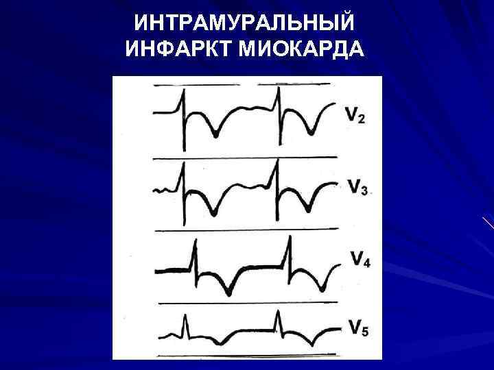 ИНТРАМУРАЛЬНЫЙ ИНФАРКТ МИОКАРДА 