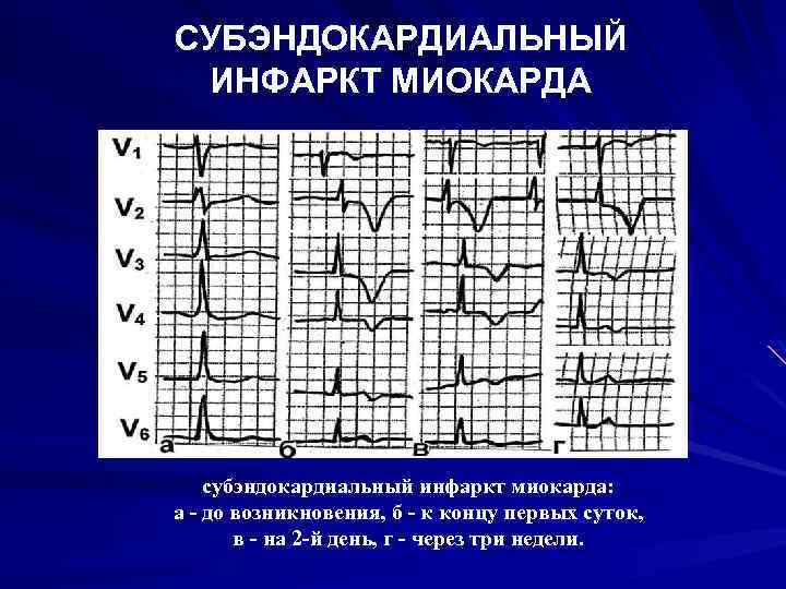 Карта вызова инфаркт миокарда