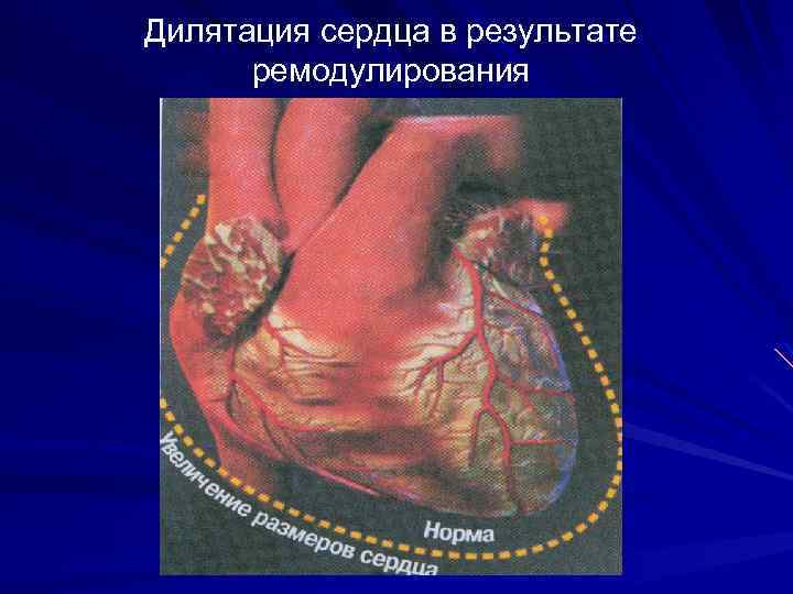 Дилятация сердца в результате ремодулирования 