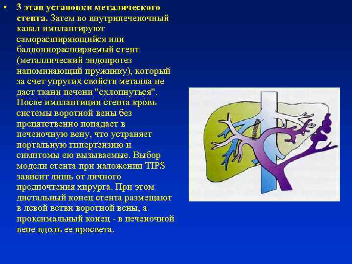 Кровотечение при портальной гипертензии