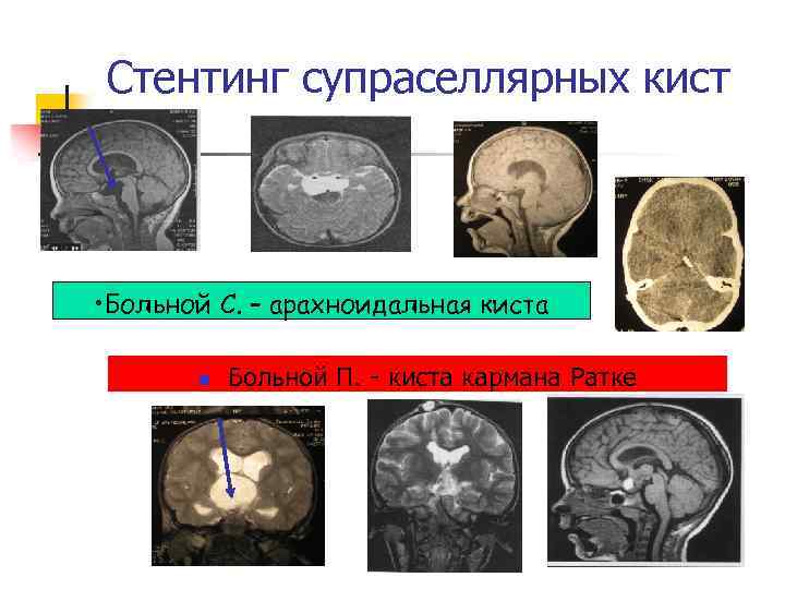 Стентинг супраселлярных кист • Больной С. – арахноидальная киста n Больной П. киста кармана