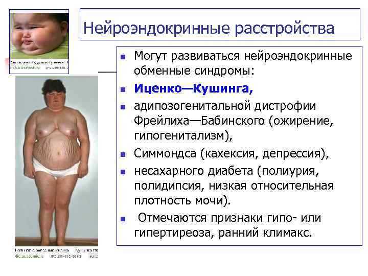 Нейроэндокринные расстройства n n n Могут развиваться нейроэндокринные обменные синдромы: Иценко—Кушинга, адипозогенитальной дистрофии Фрейлиха—Бабинского