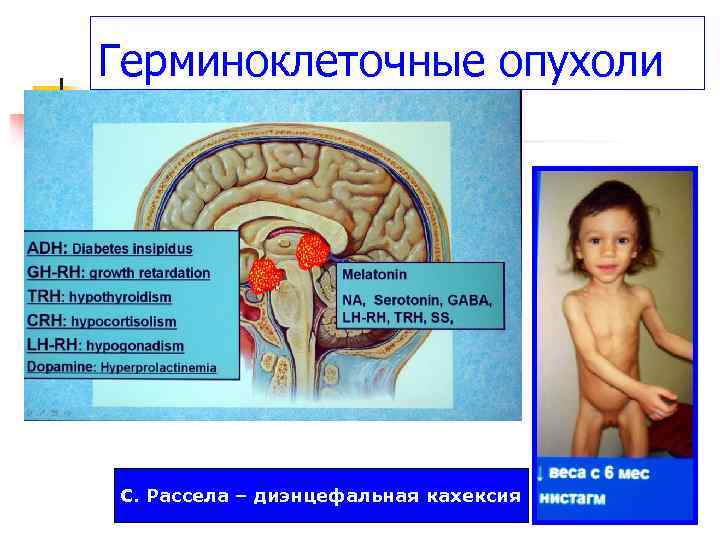Герминоклеточные опухоли С. Рассела – диэнцефальная кахексия 