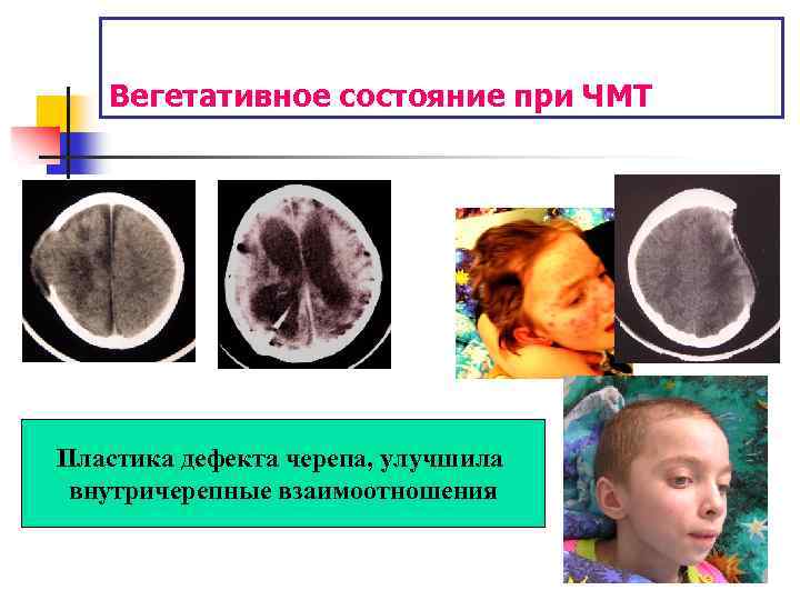 Вегетативное состояние при ЧМТ Пластика дефекта черепа, улучшила внутричерепные взаимоотношения 