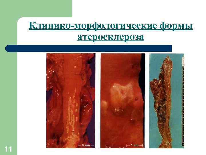 Клинико-морфологические формы атеросклероза 11 