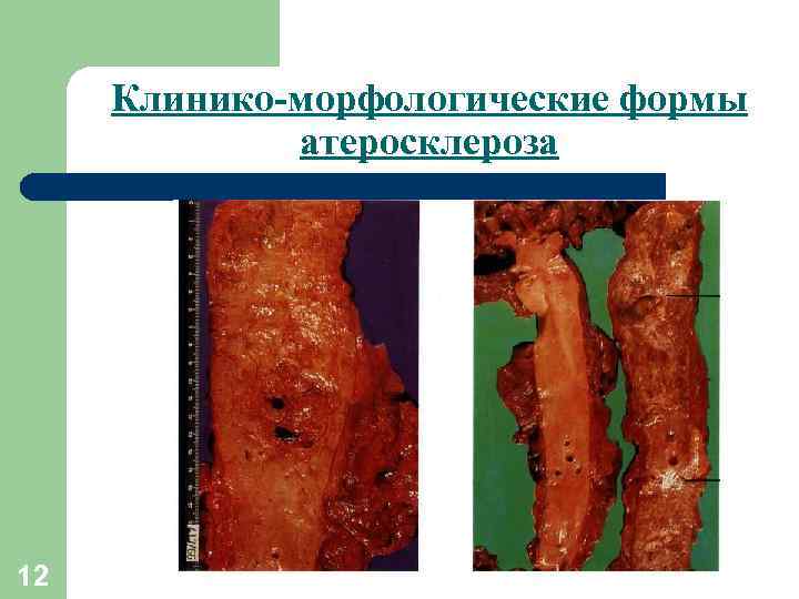 Клинико-морфологические формы атеросклероза 12 