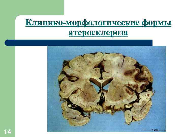 Клинико-морфологические формы атеросклероза 14 