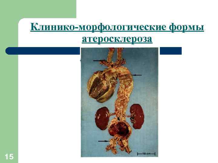 Клинико-морфологические формы атеросклероза 15 