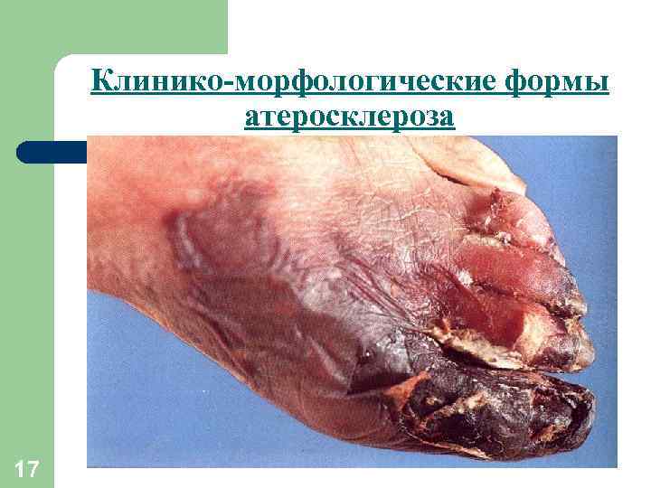 Клинико-морфологические формы атеросклероза 17 