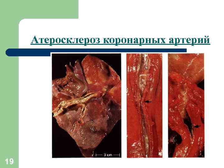 Атеросклероз коронарных артерий 19 