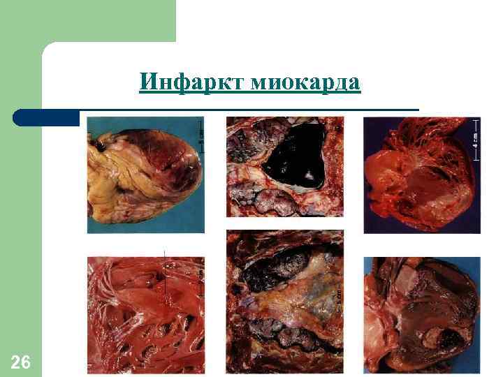 Инфаркт миокарда 26 