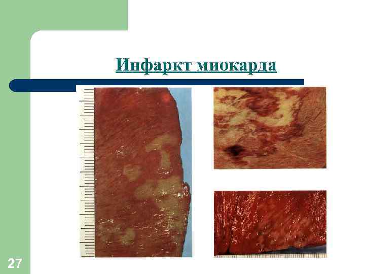 Инфаркт миокарда 27 