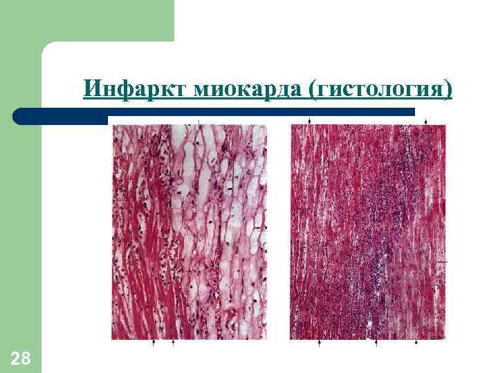 Инфаркт миокарда (гистология) 28 