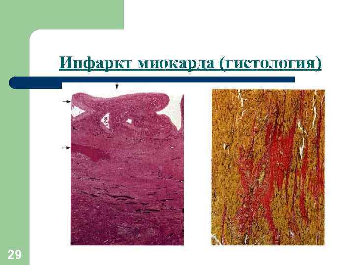 Инфаркт миокарда (гистология) 29 