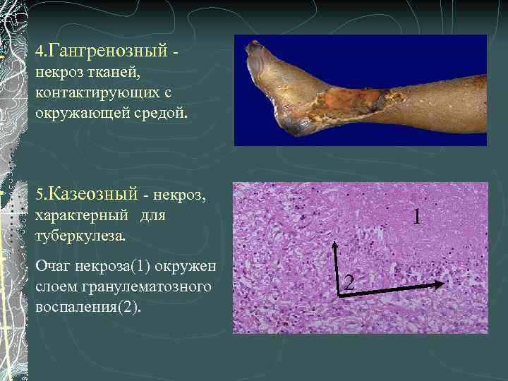 4. Гангренозный некроз тканей, контактирующих с окружающей средой. 5. Казеозный - некроз, характерный для
