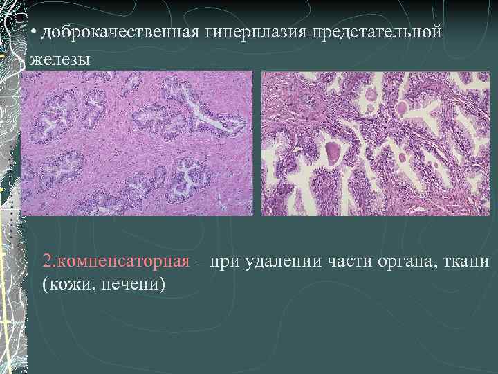  • доброкачественная гиперплазия предстательной железы 2. компенсаторная – при удалении части органа, ткани