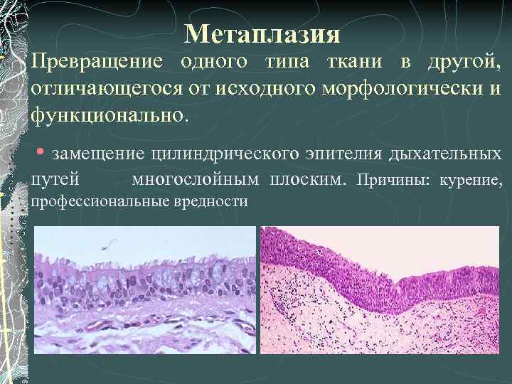 Реактивные изменения метаплазированных клеток
