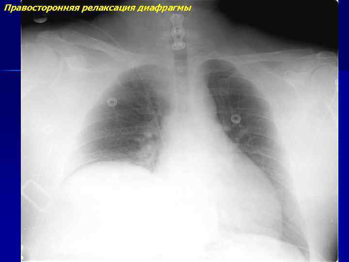 Стояние купола диафрагмы. Патология диафрагмы на рентгенограмме. Релаксация диафрагмы рентген. Миорелаксация купола диафрагмы. Грыжа купола диафрагмы рентген.