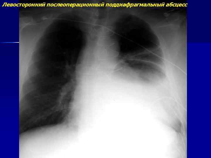 Левосторонний послеоперационный поддиафрагмальный абсцесс 