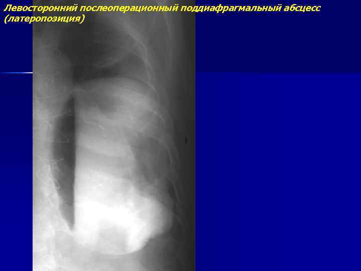 Левосторонний послеоперационный поддиафрагмальный абсцесс (латеропозиция) 