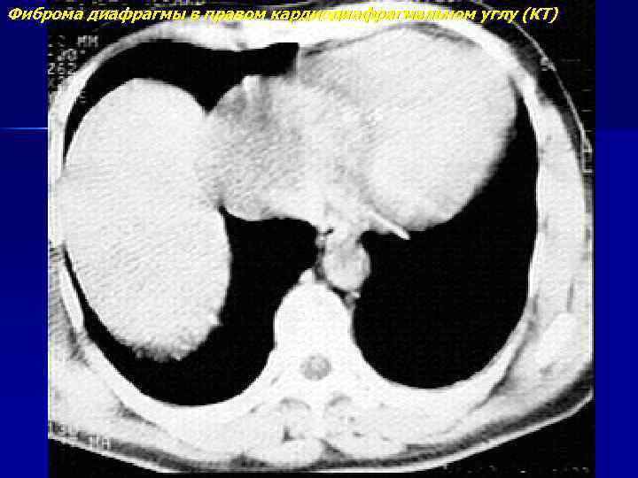Фиброма диафрагмы в правом кардиодиафрагмальном углу (КТ) 