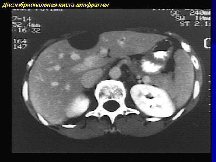 Дисэмбриональная киста диафрагмы 