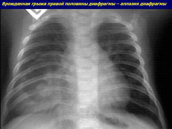 Врожденная грыжа правой половины диафрагмы – аплазия диафрагмы 