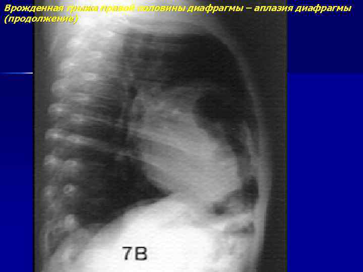 Врожденная грыжа правой половины диафрагмы – аплазия диафрагмы (продолжение) 