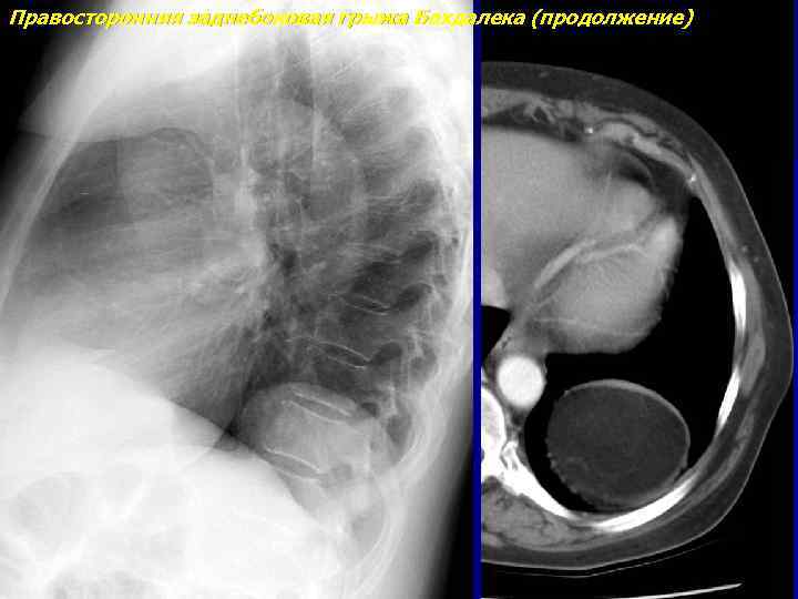 Правосторонняя заднебоковая грыжа Бохдалека (продолжение) 