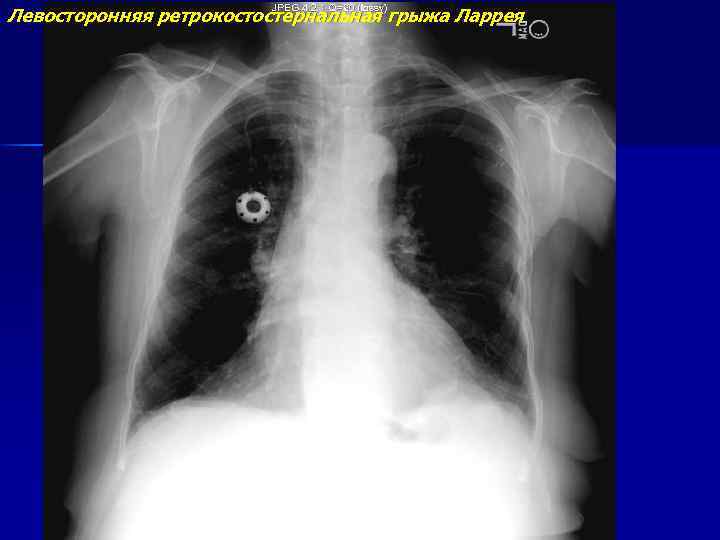 Левосторонняя ретрокостостернальная грыжа Ларрея 