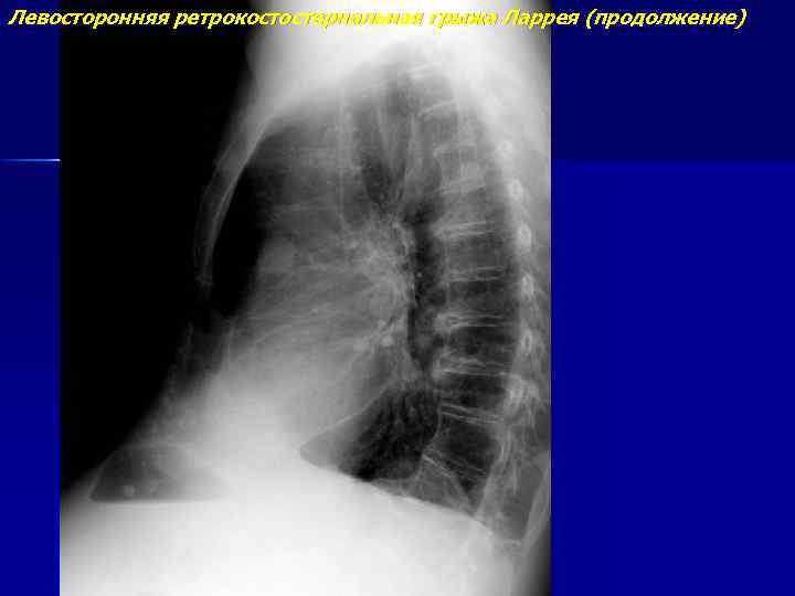 Левосторонняя ретрокостостернальная грыжа Ларрея (продолжение) 