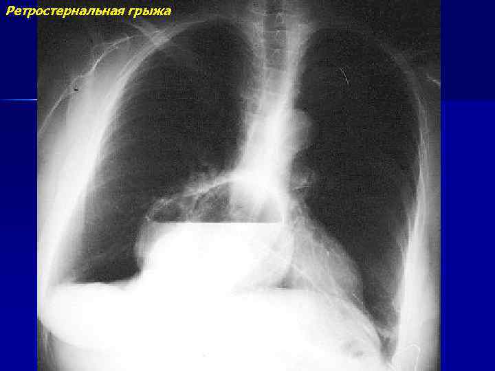 Ретростернальная грыжа 