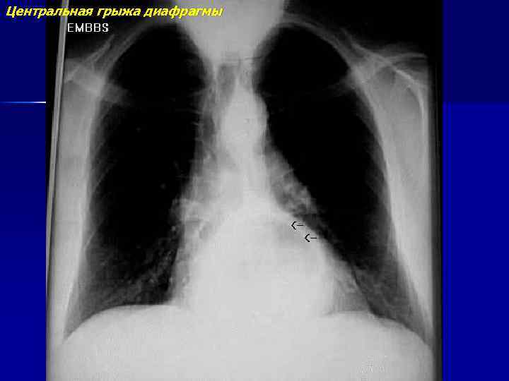 Центральная грыжа диафрагмы 