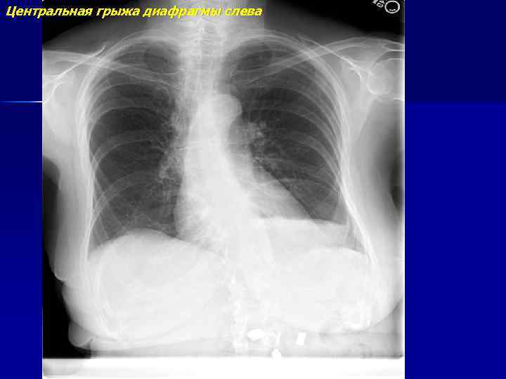 Центральная грыжа диафрагмы слева 