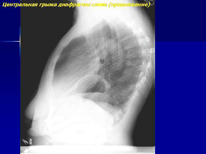 Центральная грыжа диафрагмы слева (продолжение) 