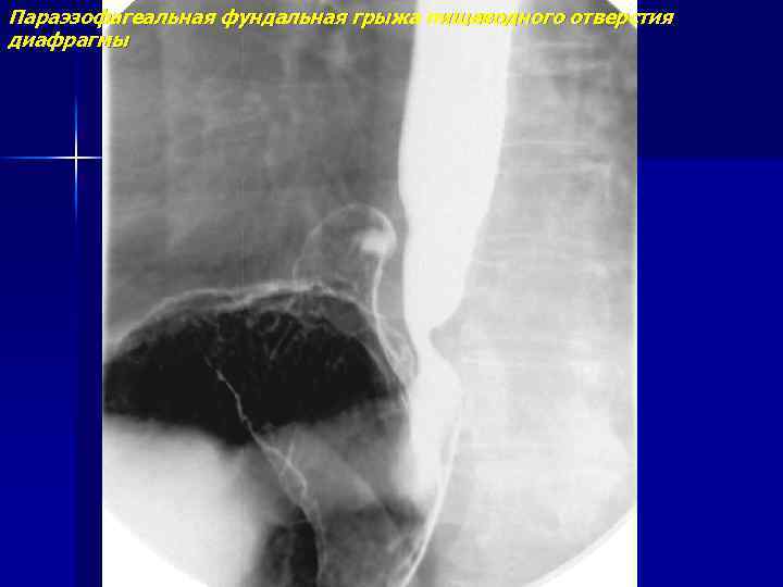 Параэзофагеальная фундальная грыжа пищеводного отверстия диафрагмы 