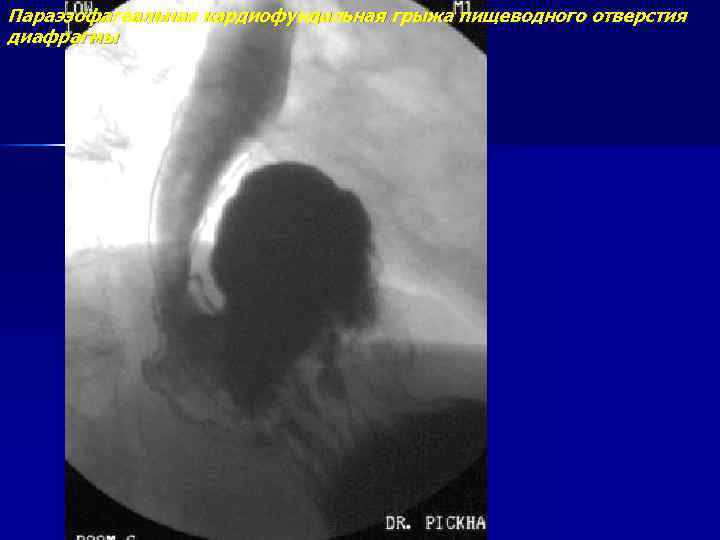 Параэзофагеальная кардиофундальная грыжа пищеводного отверстия диафрагмы 