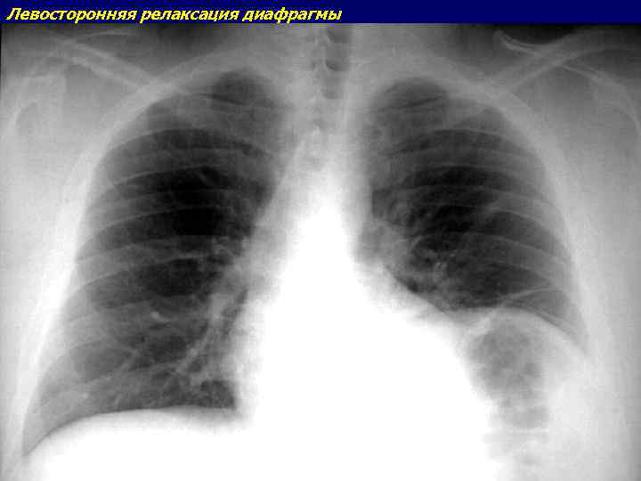 Стояние купола диафрагмы. Релаксация левого купола диафрагмы рентген. Релаксация правого купола диафрагмы рентген. Опухоли диафрагмы рентген. Грыжа купола диафрагмы рентген.