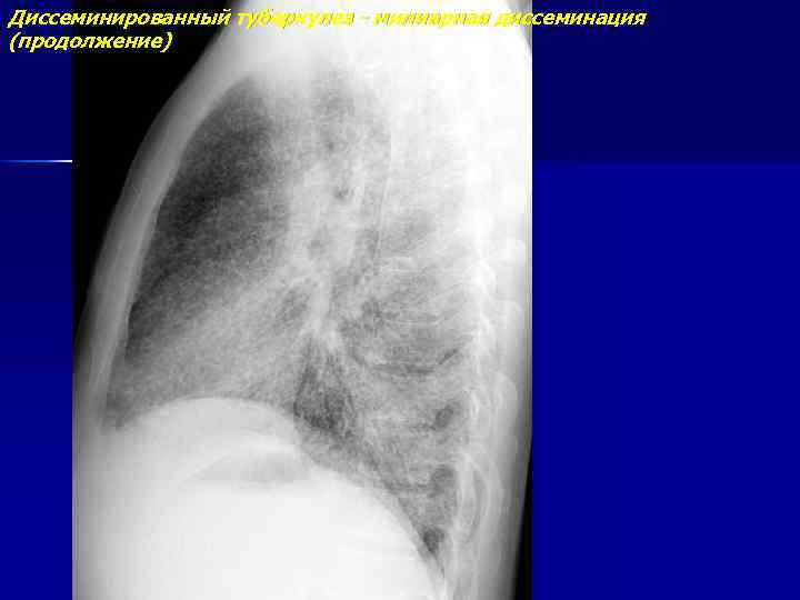 Диссеминированный туберкулез - милиарная диссеминация (продолжение) 