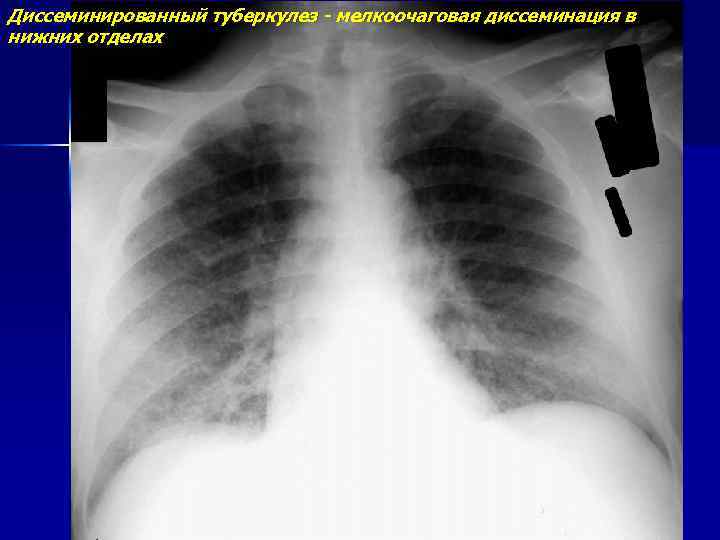 Диссеминированный туберкулез - мелкоочаговая диссеминация в нижних отделах 