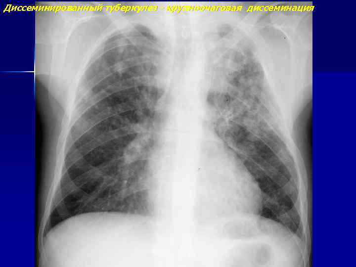 Диссеминированный туберкулез - крупноочаговая диссеминация 