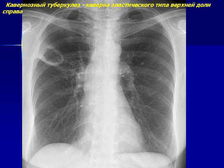 Кавернозный туберкулез - каверна эластического типа верхней доли справа 