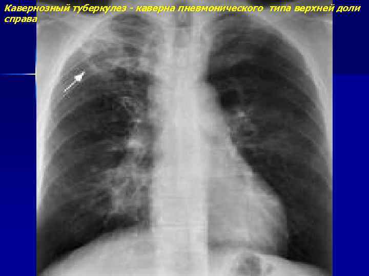 Кавернозный туберкулез - каверна пневмонического типа верхней доли справа 